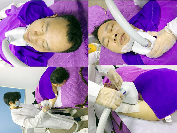 360 degree cryolipolysis treatment