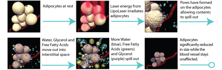 lipo-laser-process.jpg